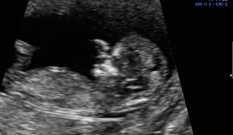 Semana 11 de embarazo - inatal - El embarazo semana semana