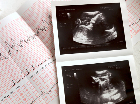 semana6 ecografia corazon embrion